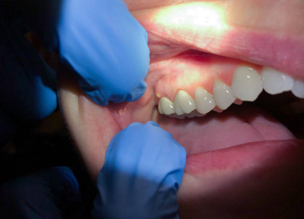 Best Emergency Denture Repair in Uniontown, PA